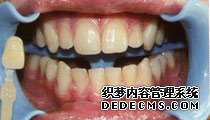 遗传性黄牙